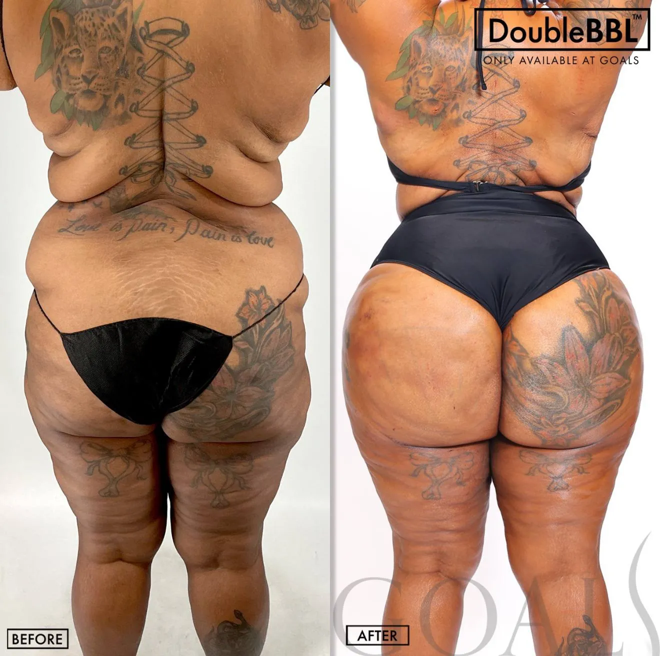 Before and after — Los Angeles, patient 2