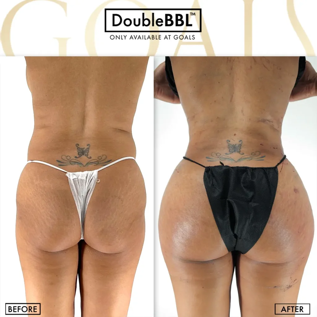 Before and after — BBL, BMI 20 to 25, patient 6