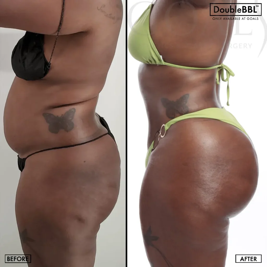 Brazilian Butt Lift — patient result