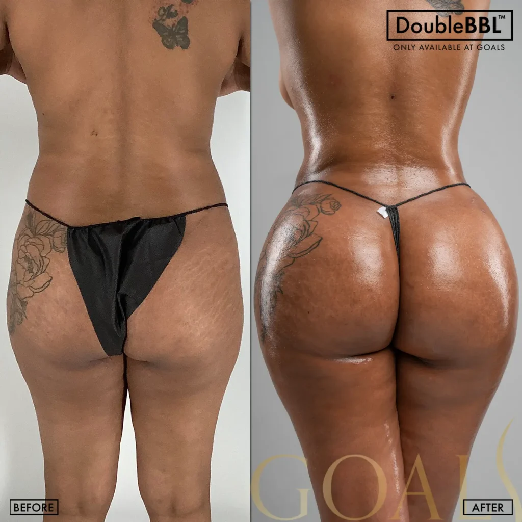Brazilian Butt Lift — patient result