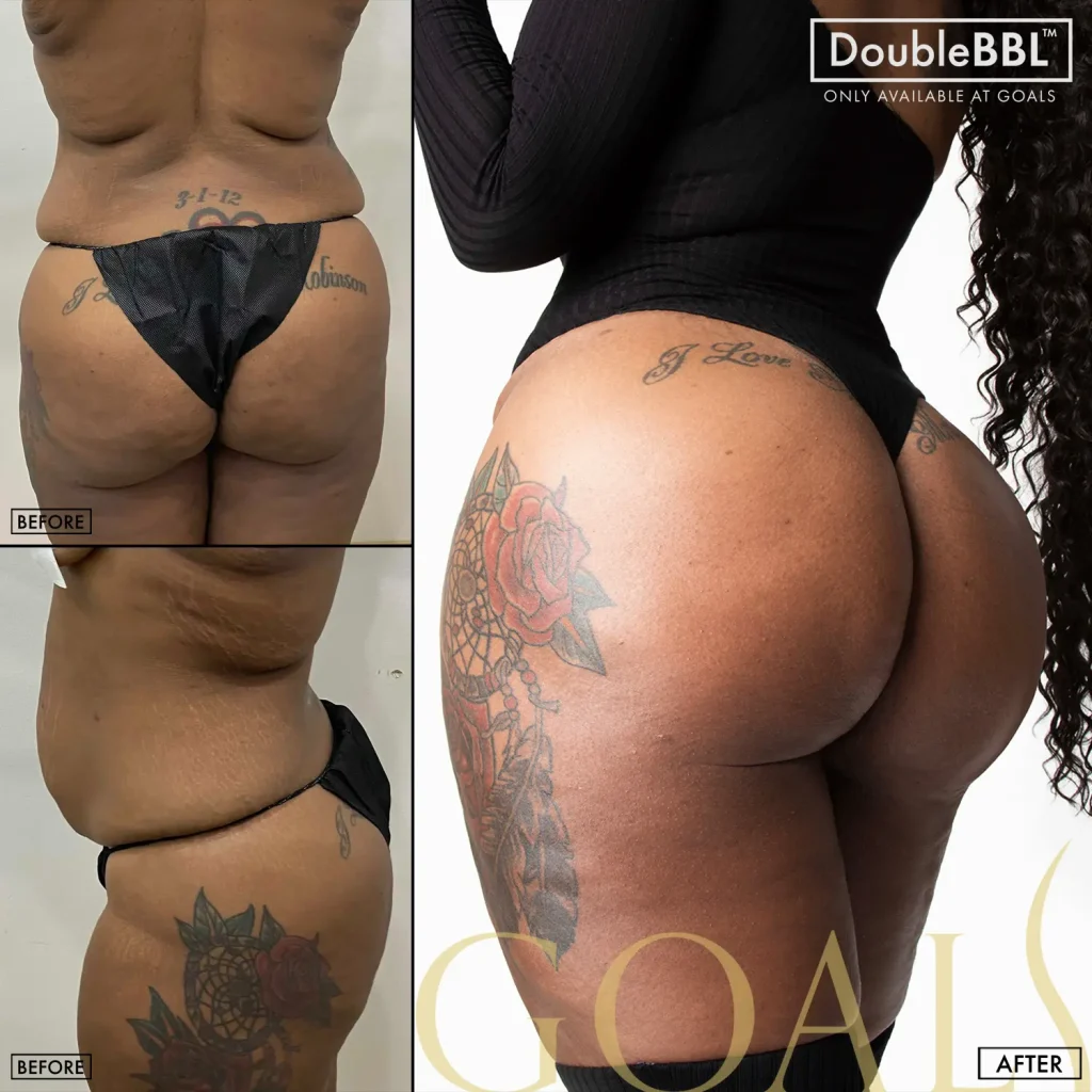 Before and after — Harlem, patient 4