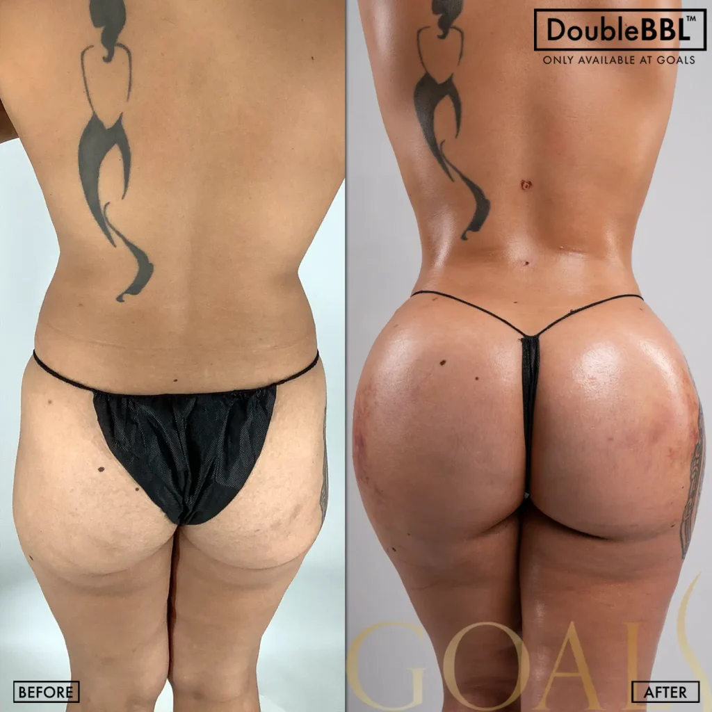 Before and after — Brazilian Butt Lift · Gaithersburg, patient 1
