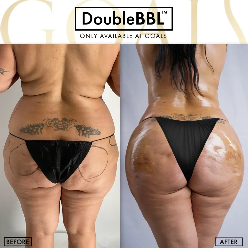 Before and after — Brazilian Butt Lift · Gaithersburg, patient 2