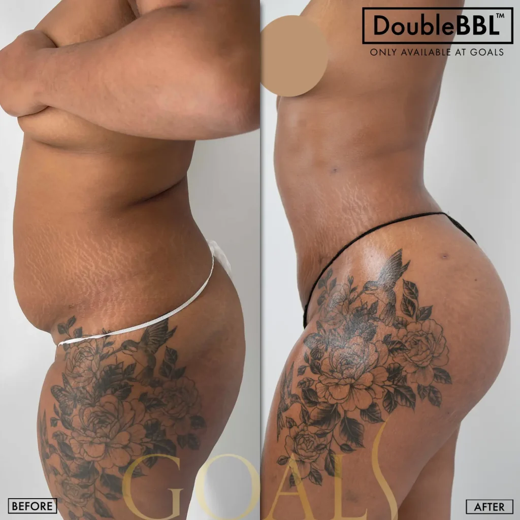 Before and after — Brazilian Butt Lift · Gaithersburg, patient 3