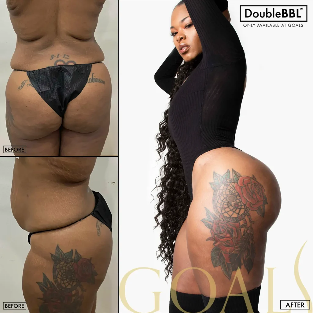 Before and after — Brazilian Butt Lift · Gaithersburg, patient 4