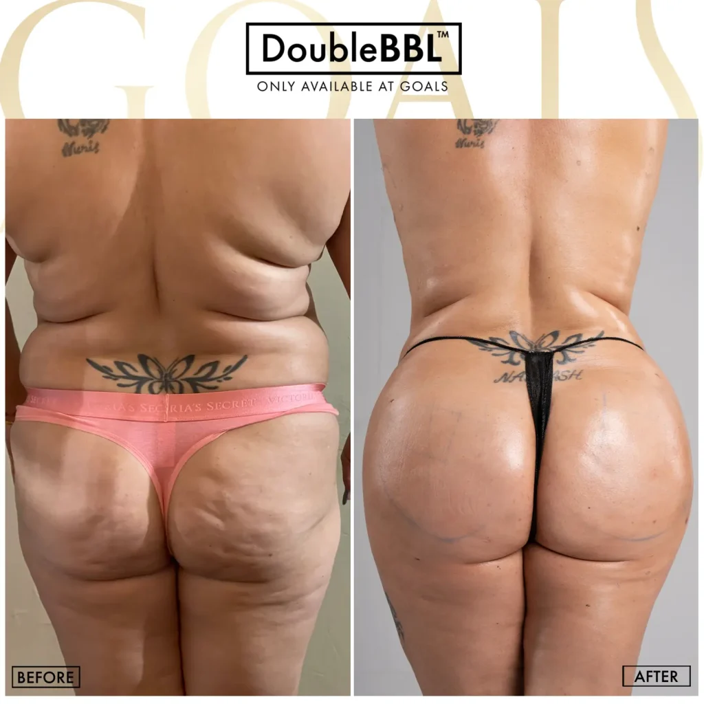 Before and after — Brazilian Butt Lift · Gaithersburg, patient 5