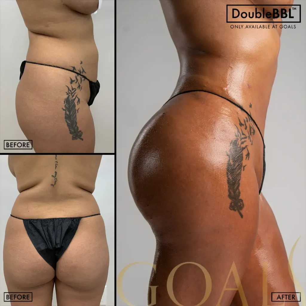 Before and after — Brazilian Butt Lift · Gaithersburg, patient 6