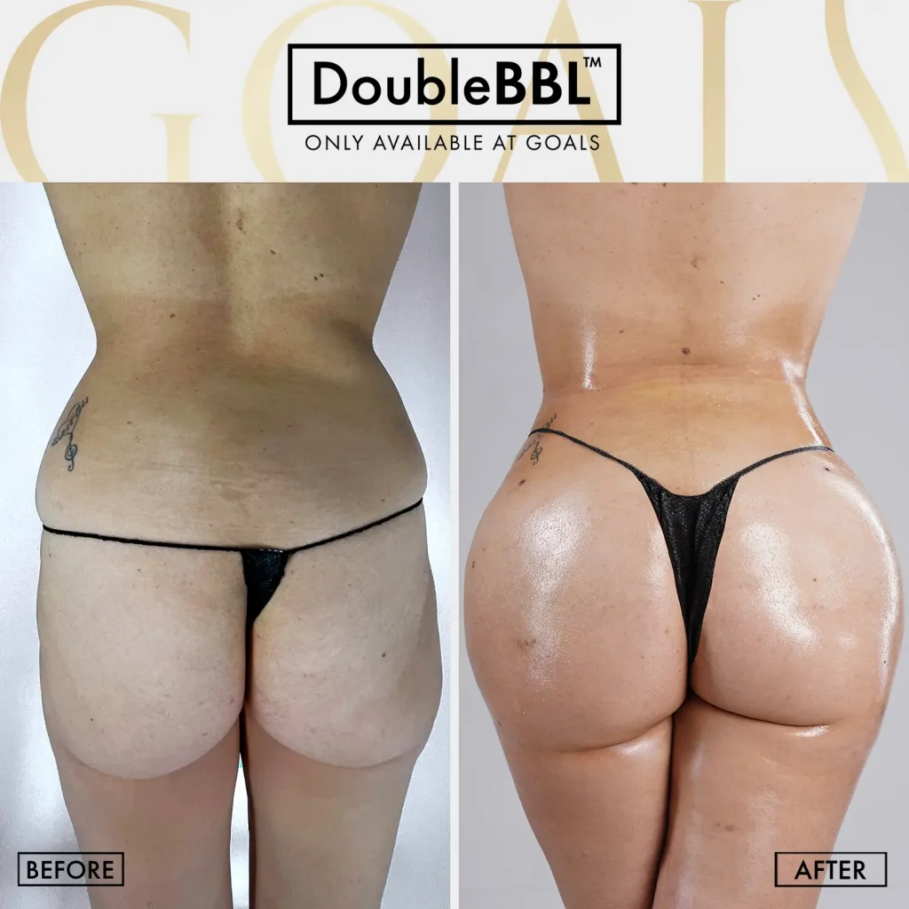 Before and after — Brazilian Butt Lift · Philadelphia, patient 4