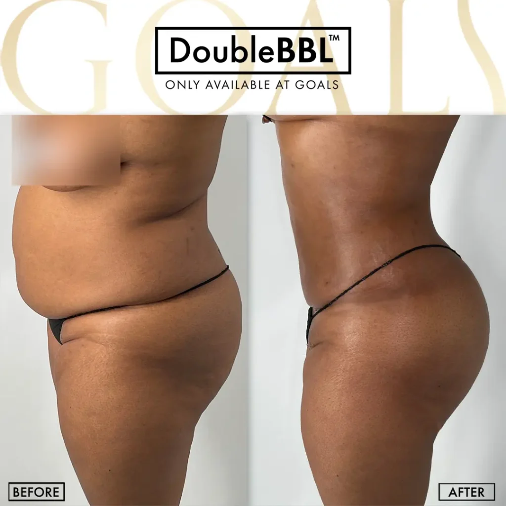 A Goals patient's brazilian butt lift result