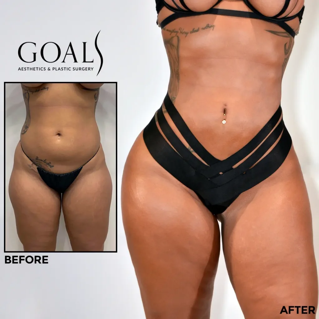 A Goals patient's brazilian butt lift result