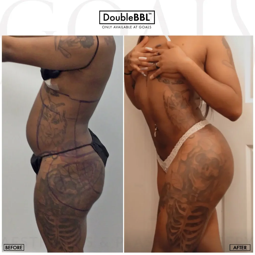 Before and after — Bronx, patient 6