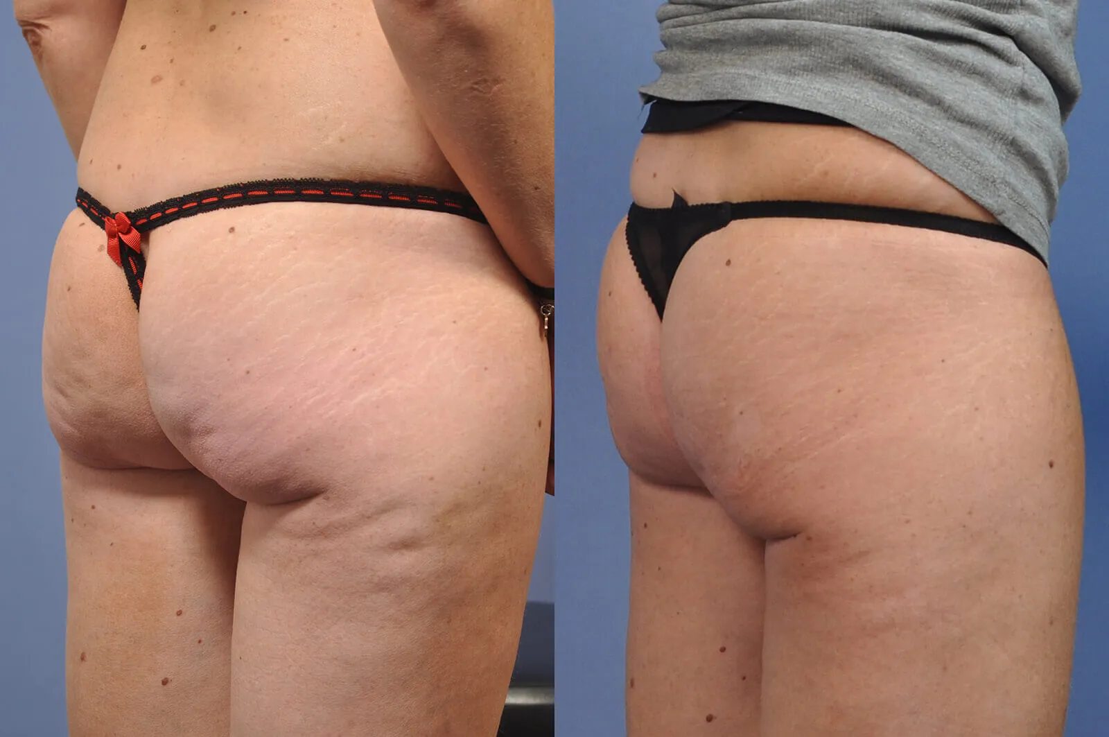 Before and after — Brazilian Butt Lift · Los Angeles, patient 1