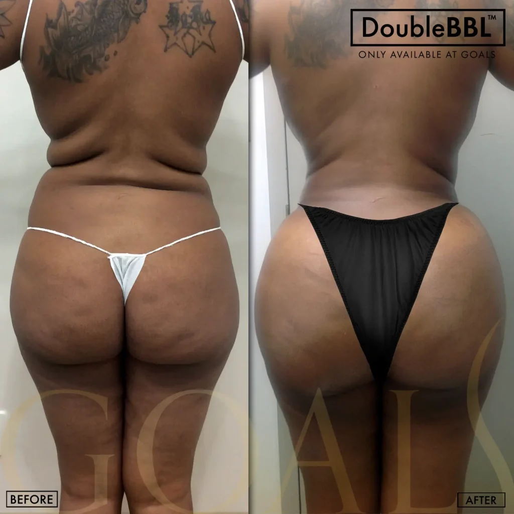 Before and after — Brazilian Butt Lift · Los Angeles, patient 2