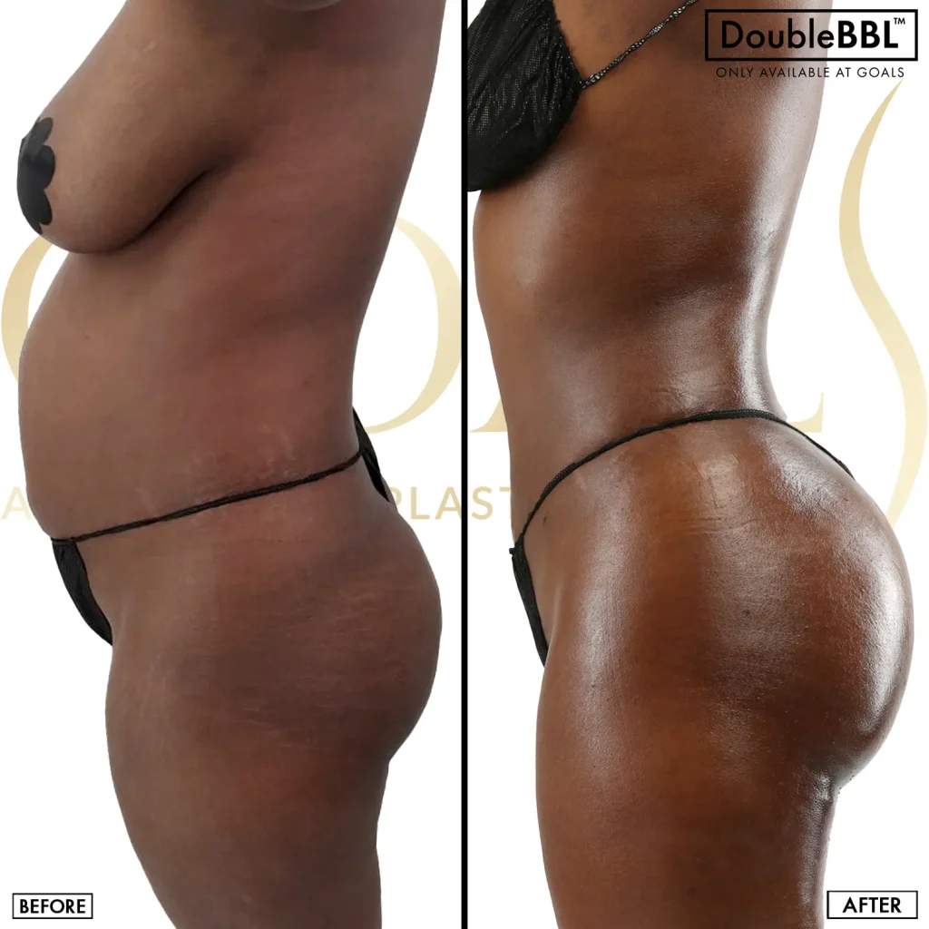 Before and after — Brazilian Butt Lift · Los Angeles, patient 5
