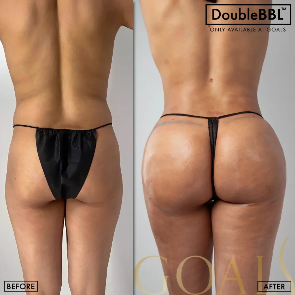 Before and after — Brazilian Butt Lift · Los Angeles, patient 6