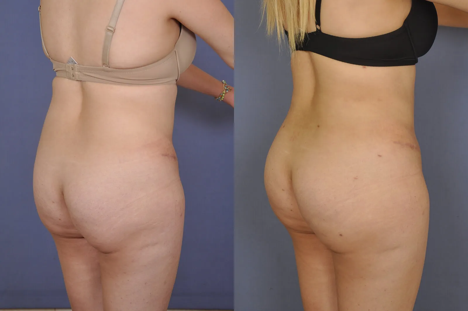 Before and after — Philadelphia, patient 1