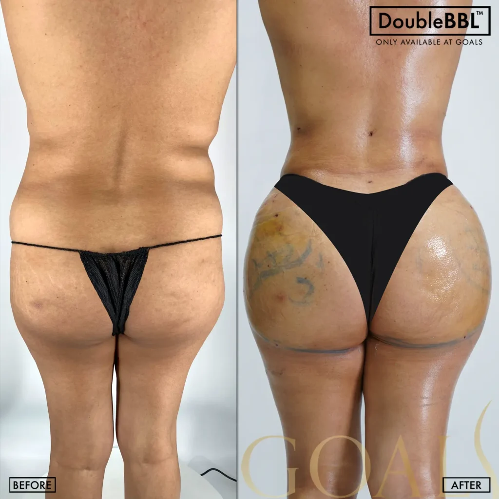 Before and after — Philadelphia, patient 4