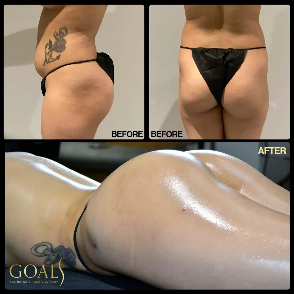 Brazilian Butt Lift — patient result