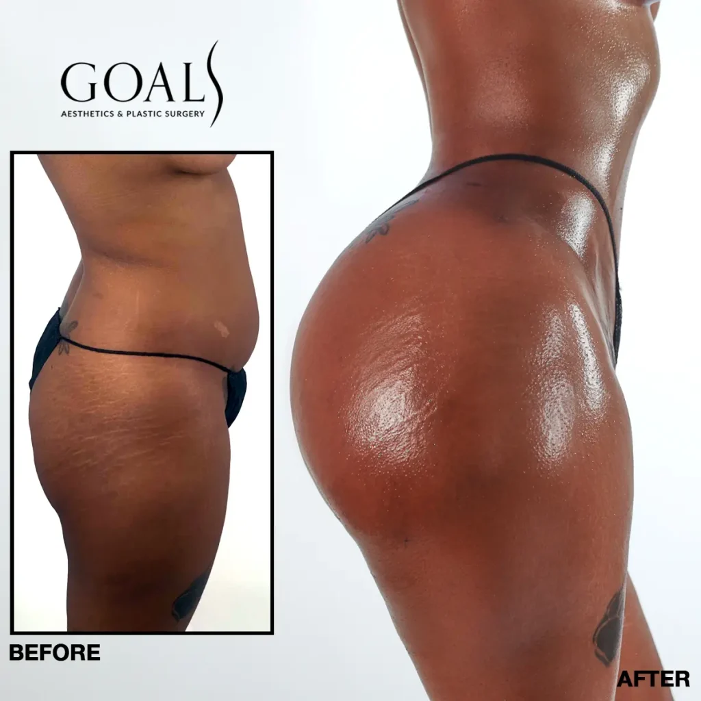 A Goals patient's brazilian butt lift result