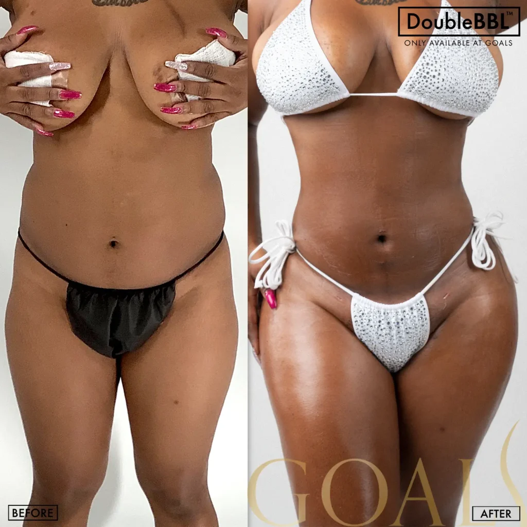 Before and after — Bronx, patient 3