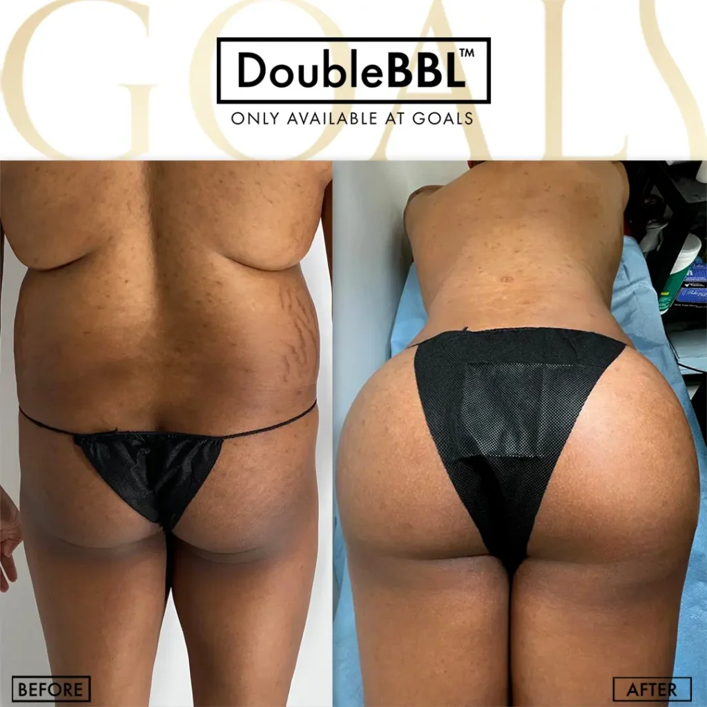 Before and after — Brazilian Butt Lift · Harlem, patient 1