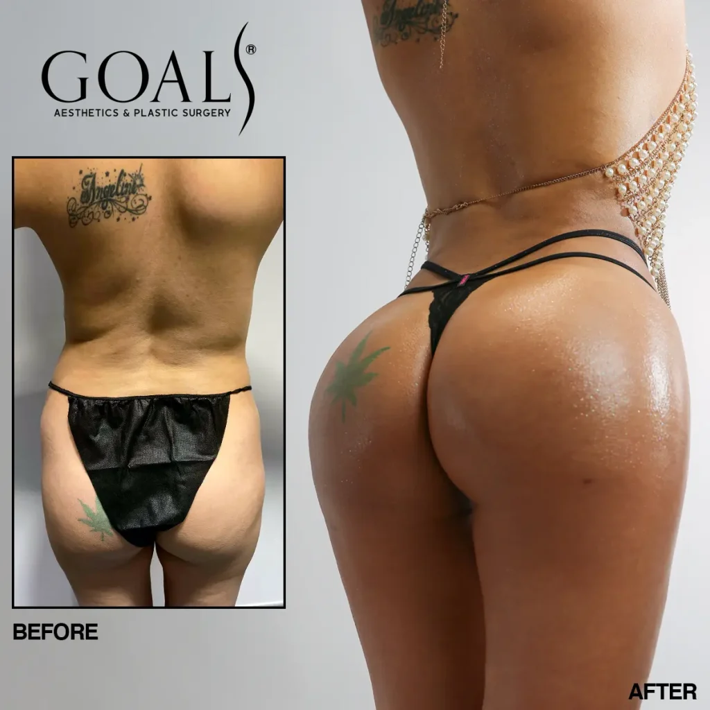 Before and after — Brazilian Butt Lift · Harlem, patient 2