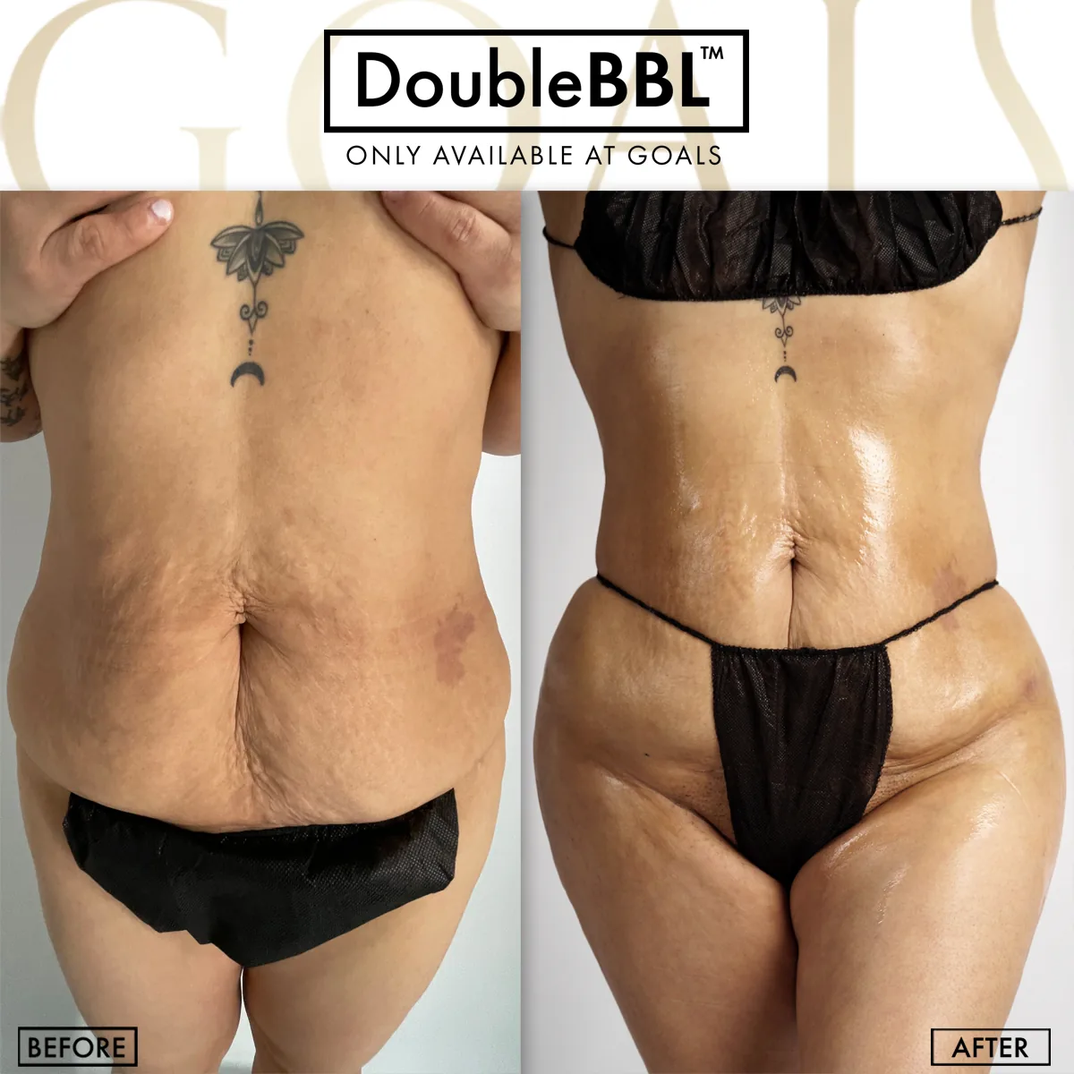 Before and after — Brazilian Butt Lift · Harlem, patient 3