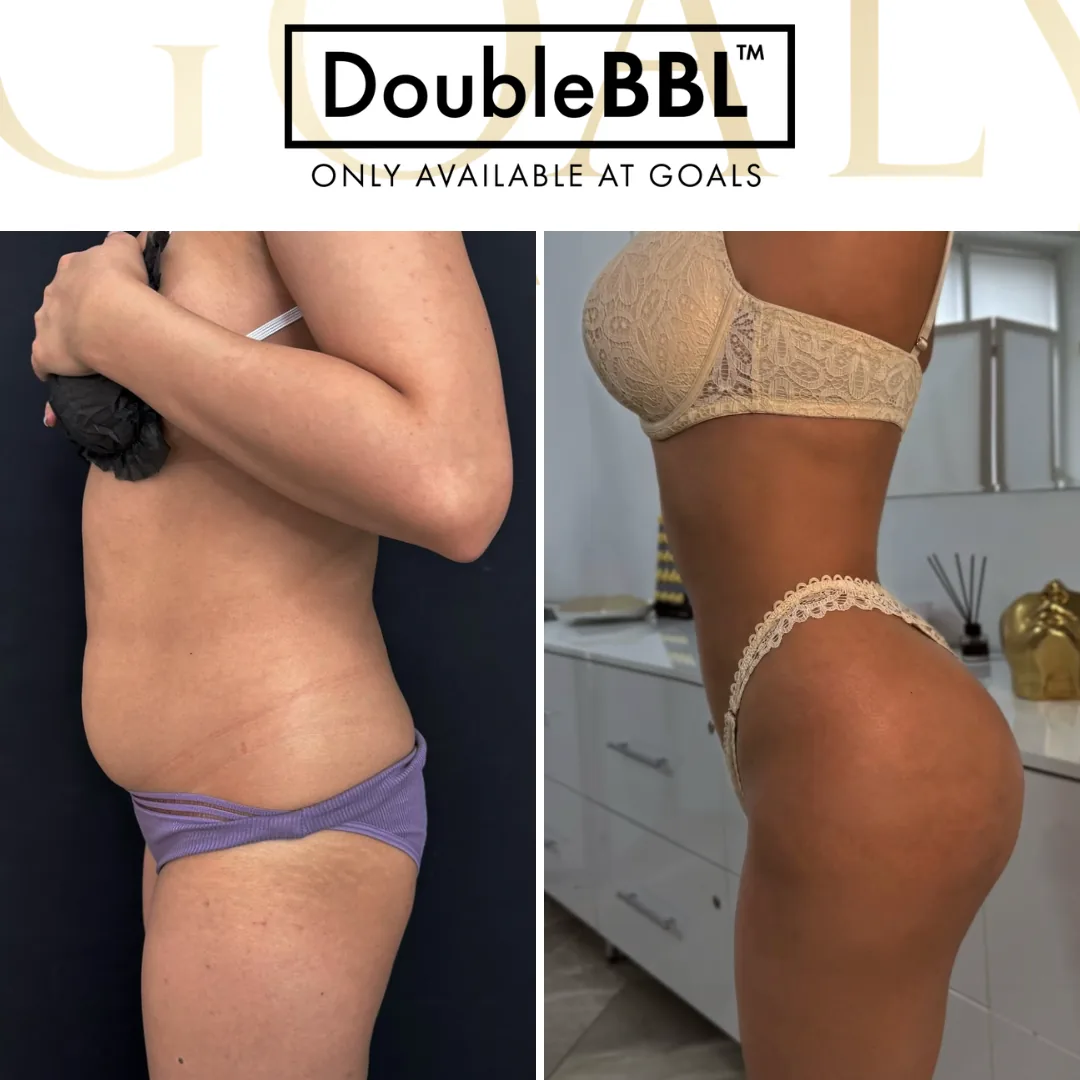 Before and after — Brazilian Butt Lift · Harlem, patient 4