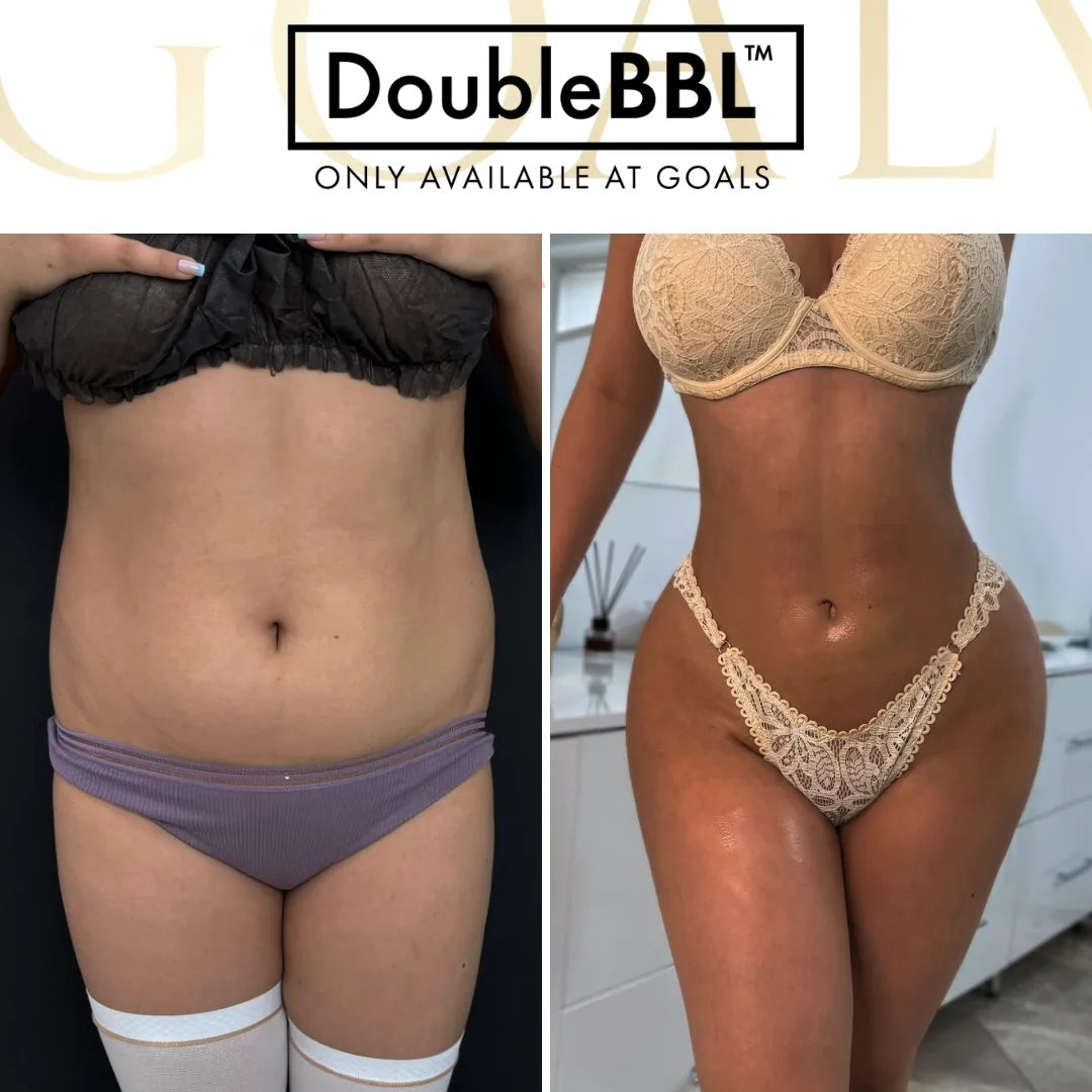 Before and after — Brazilian Butt Lift · Harlem, patient 5
