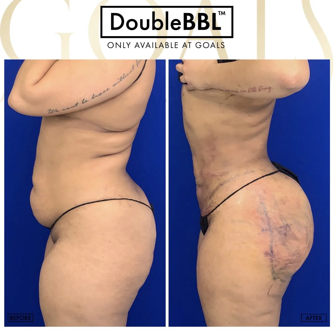 Before and after — Brazilian Butt Lift · Harlem, patient 6