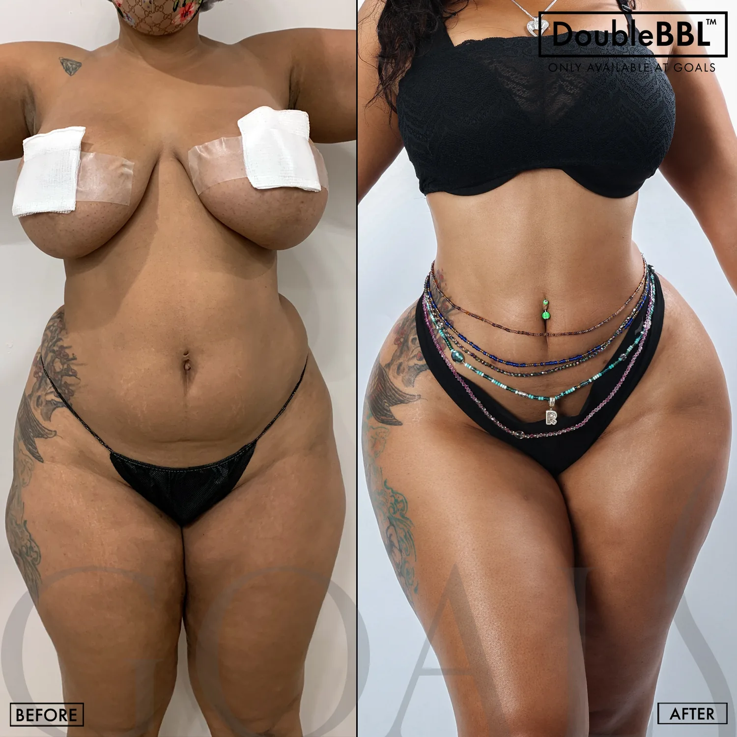Before and after — Brazilian Butt Lift · Atlanta Tucker Rd., patient 1