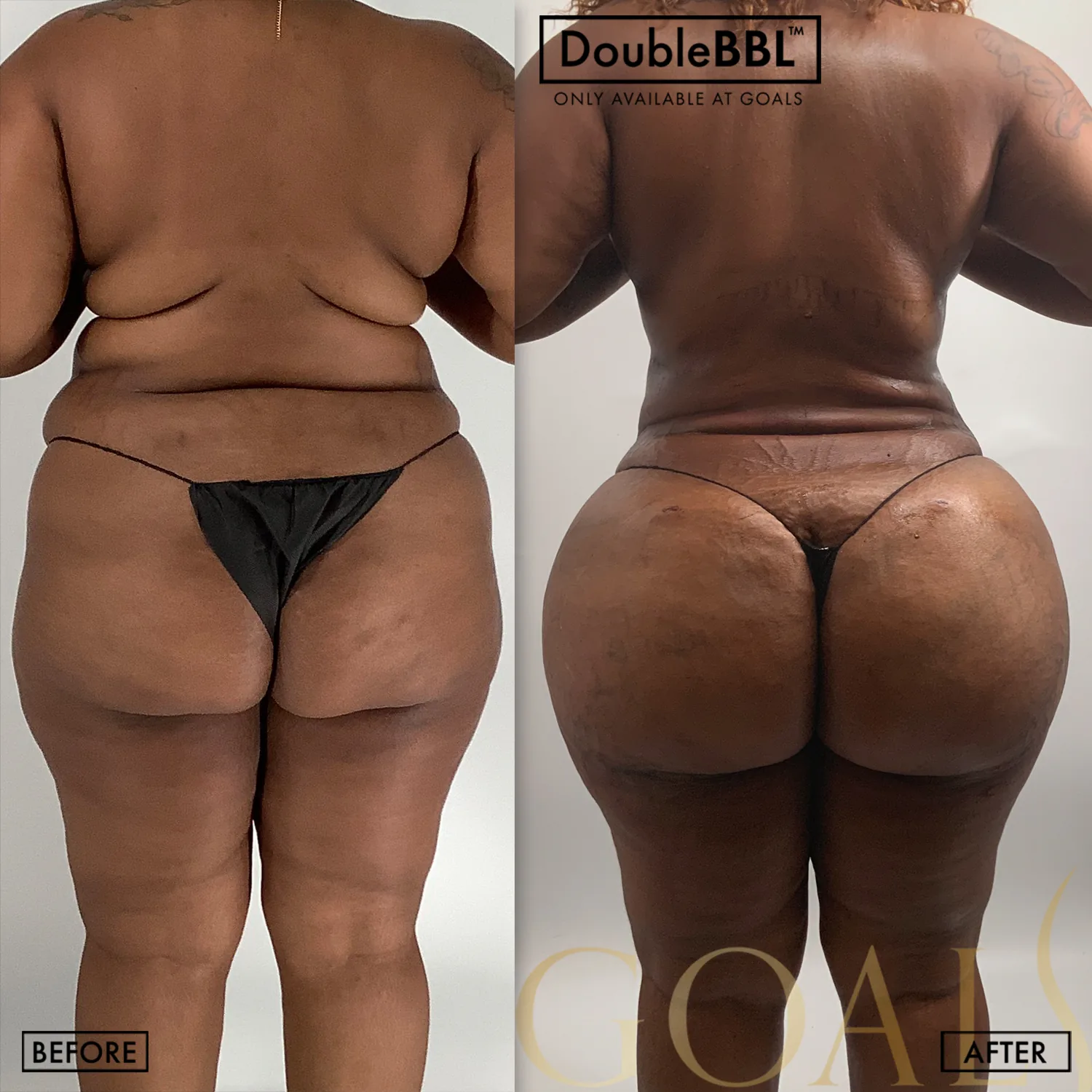 Before and after — Brazilian Butt Lift · Atlanta Tucker Rd., patient 3