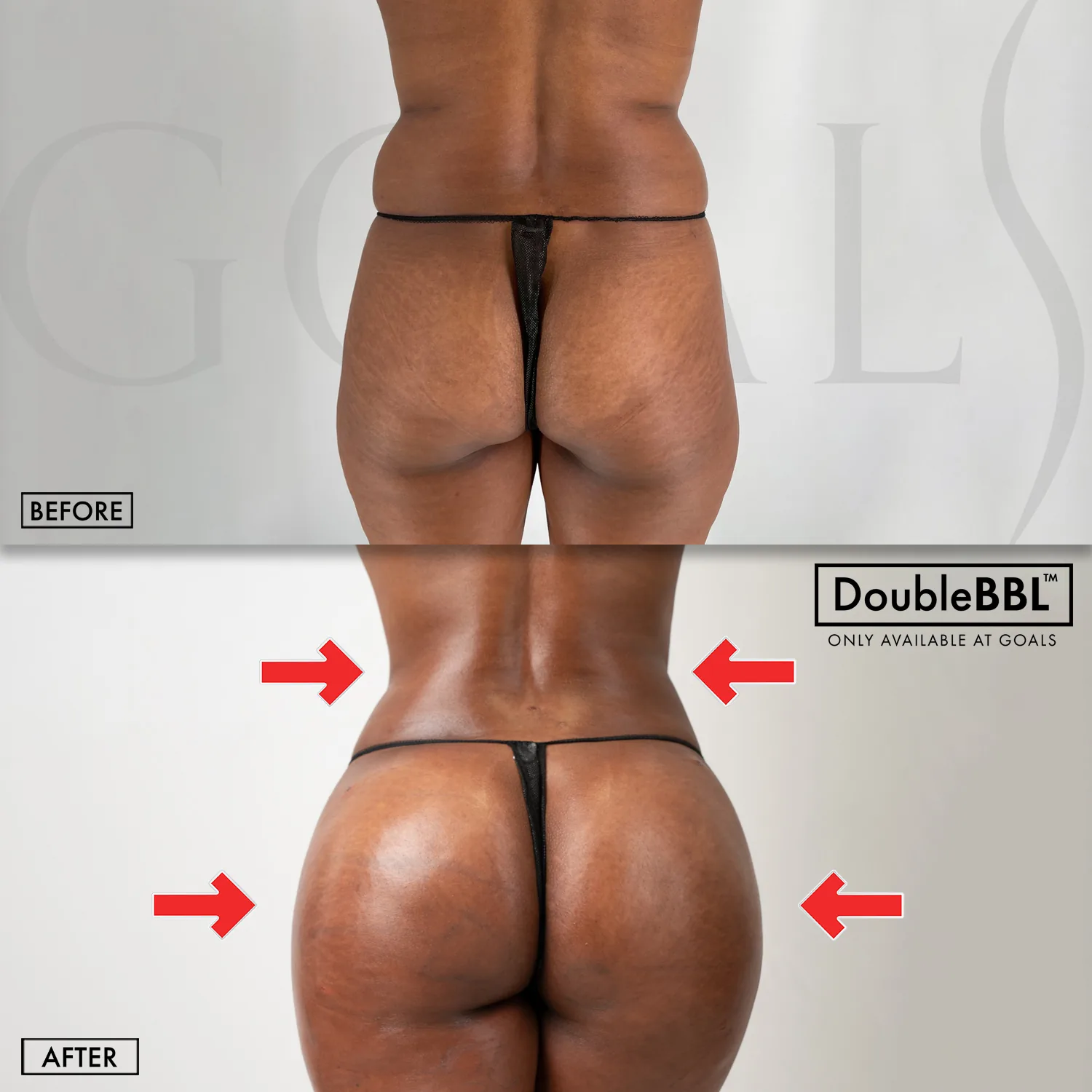 Before and after — Brazilian Butt Lift · Atlanta Tucker Rd., patient 6