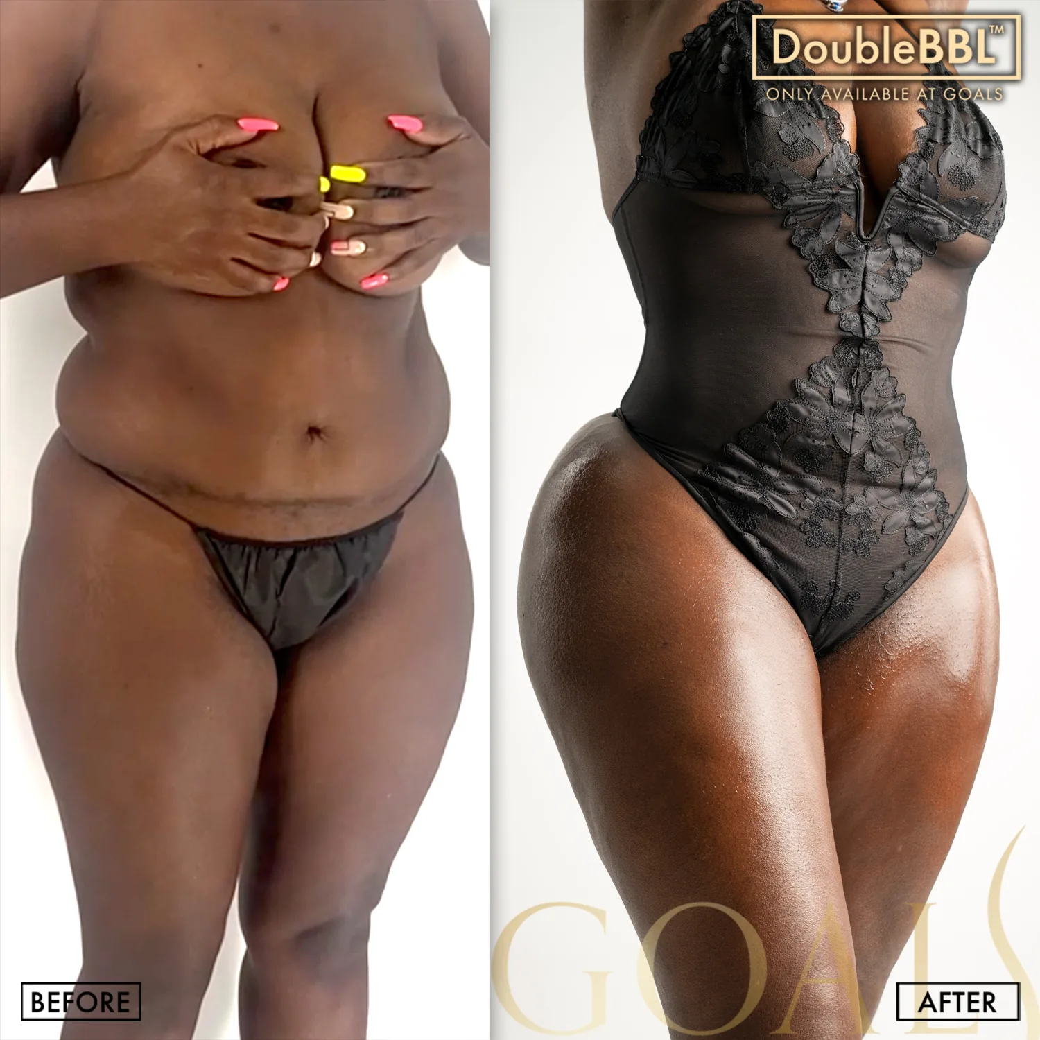 Before and after — Brazilian Butt Lift · Houston, patient 1