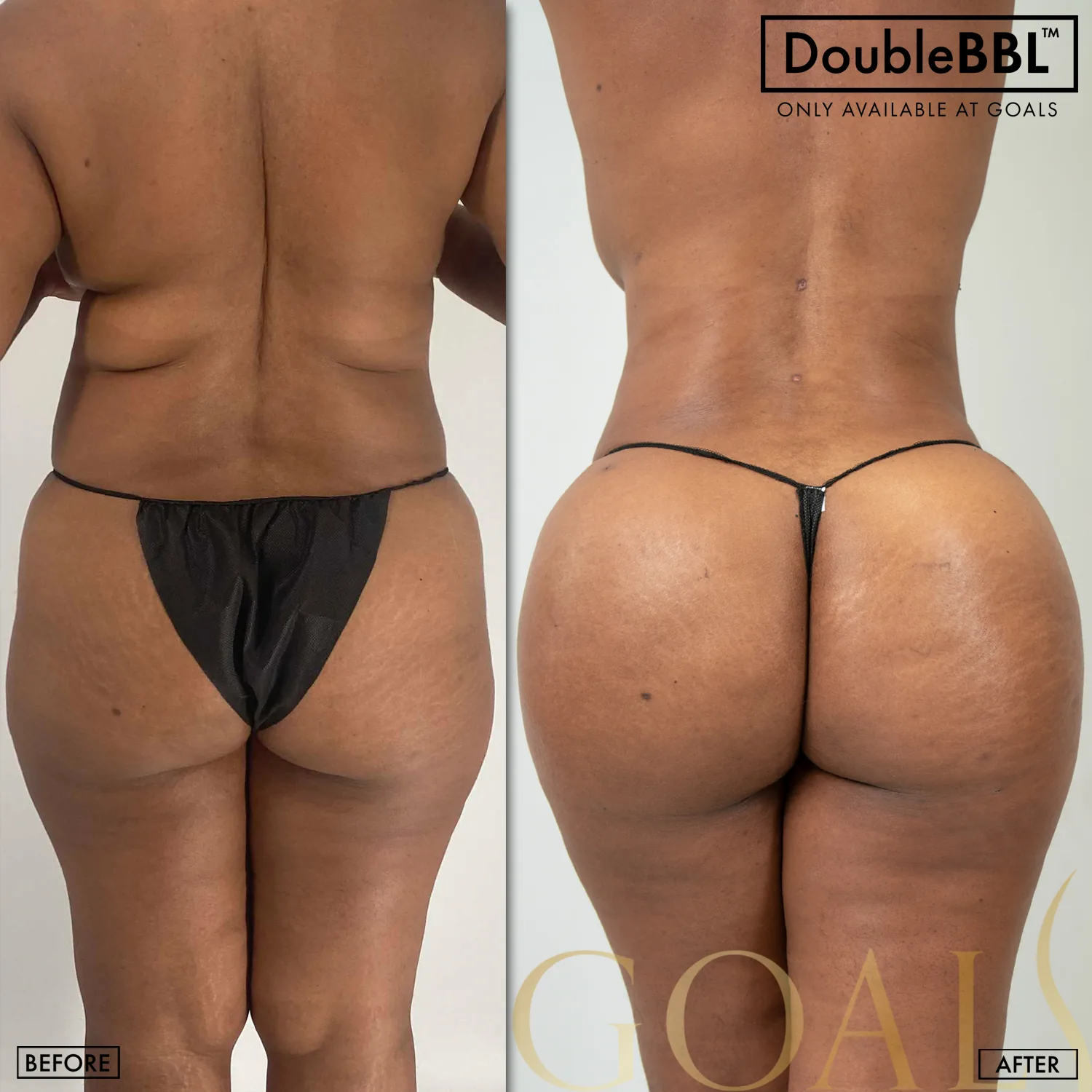 Before and after — Brazilian Butt Lift · Houston, patient 3