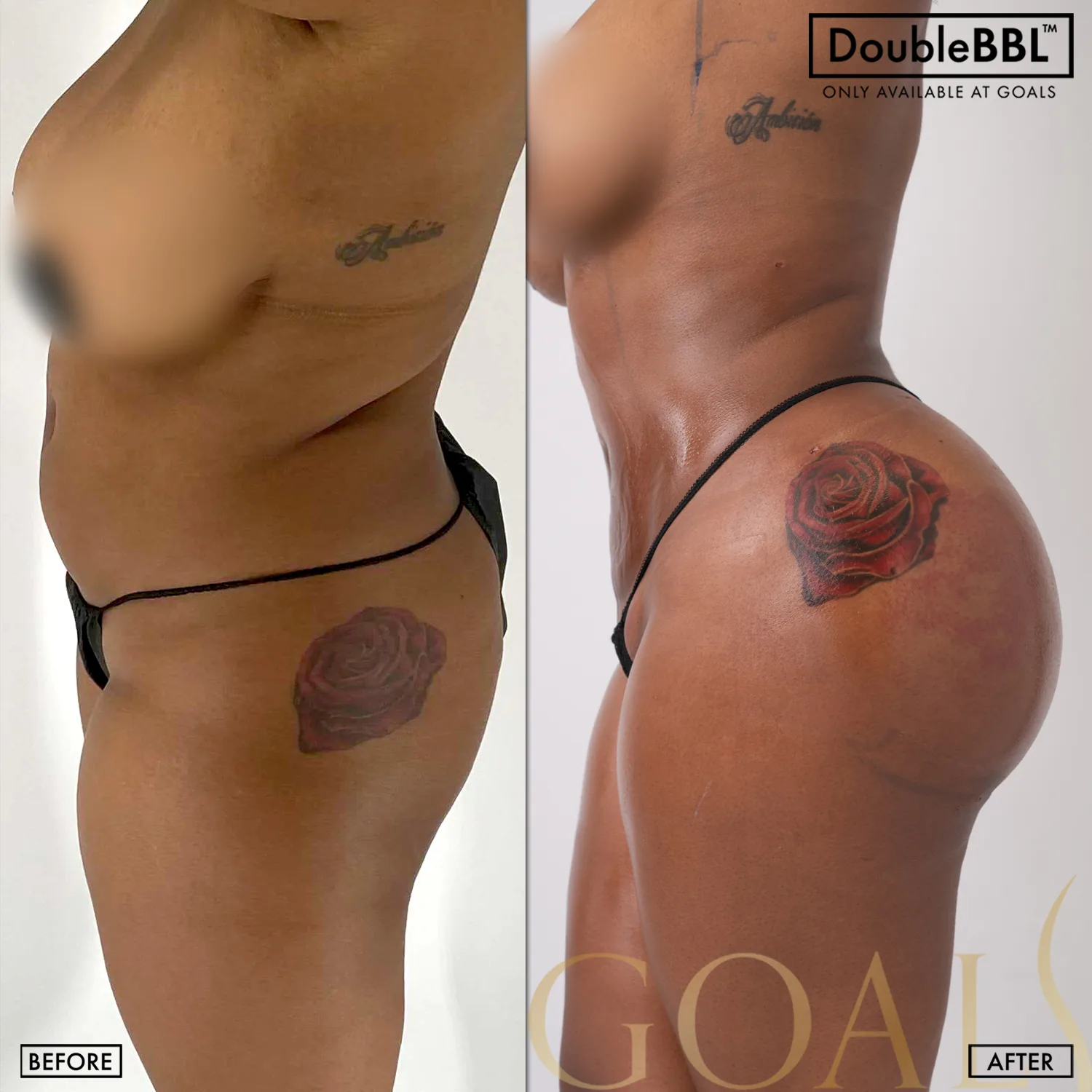 Before and after — Brazilian Butt Lift · Houston, patient 4