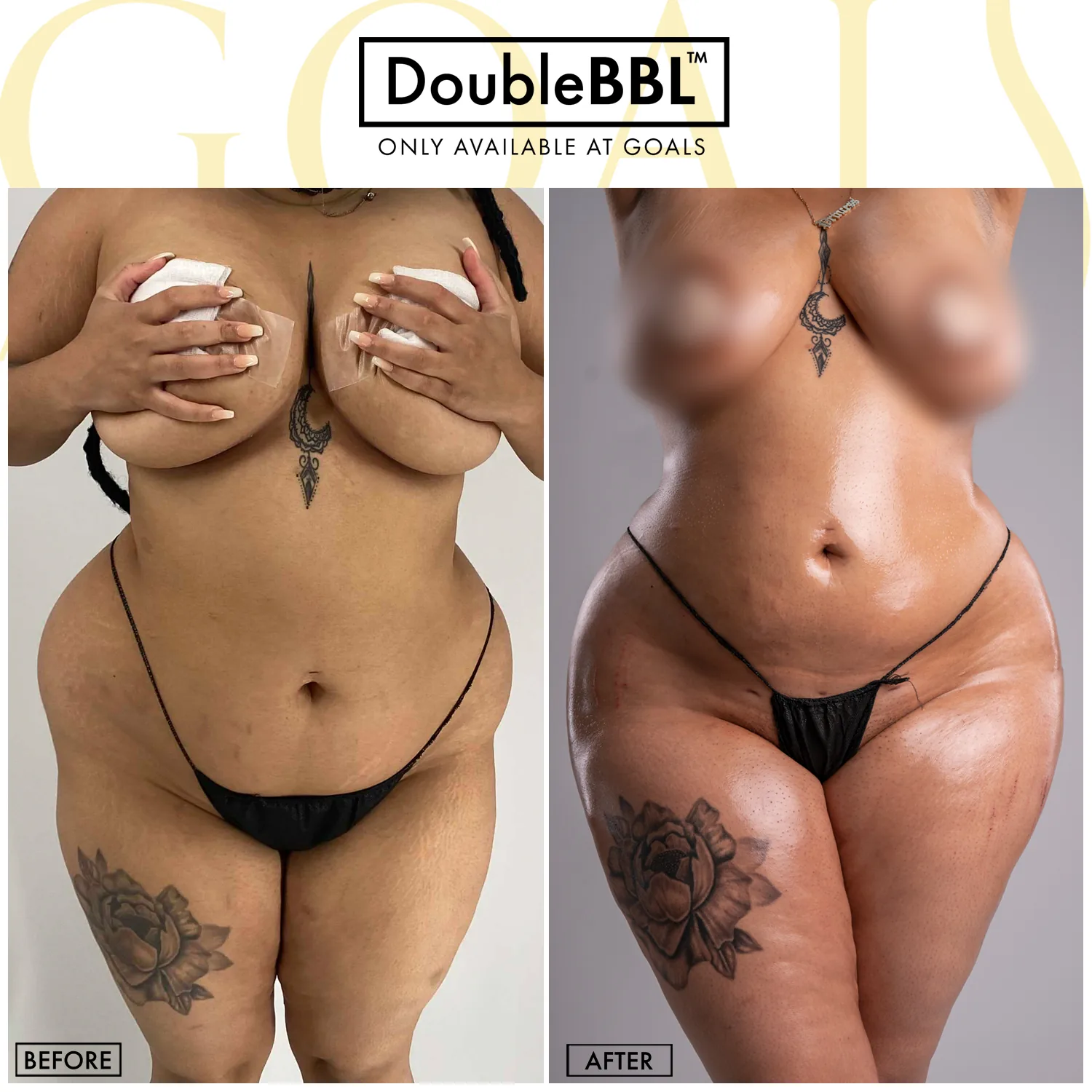 Before and after — Brazilian Butt Lift · Houston, patient 5