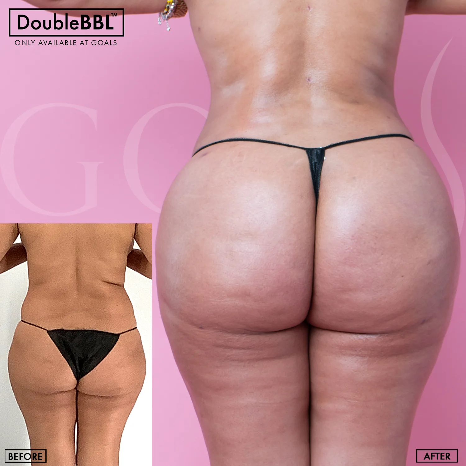 Before and after — Brazilian Butt Lift · Houston, patient 6