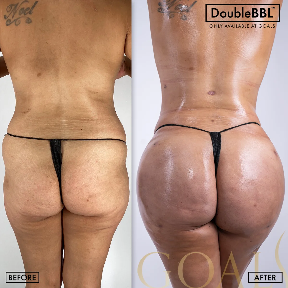 Before and after — Gaithersburg, patient 6