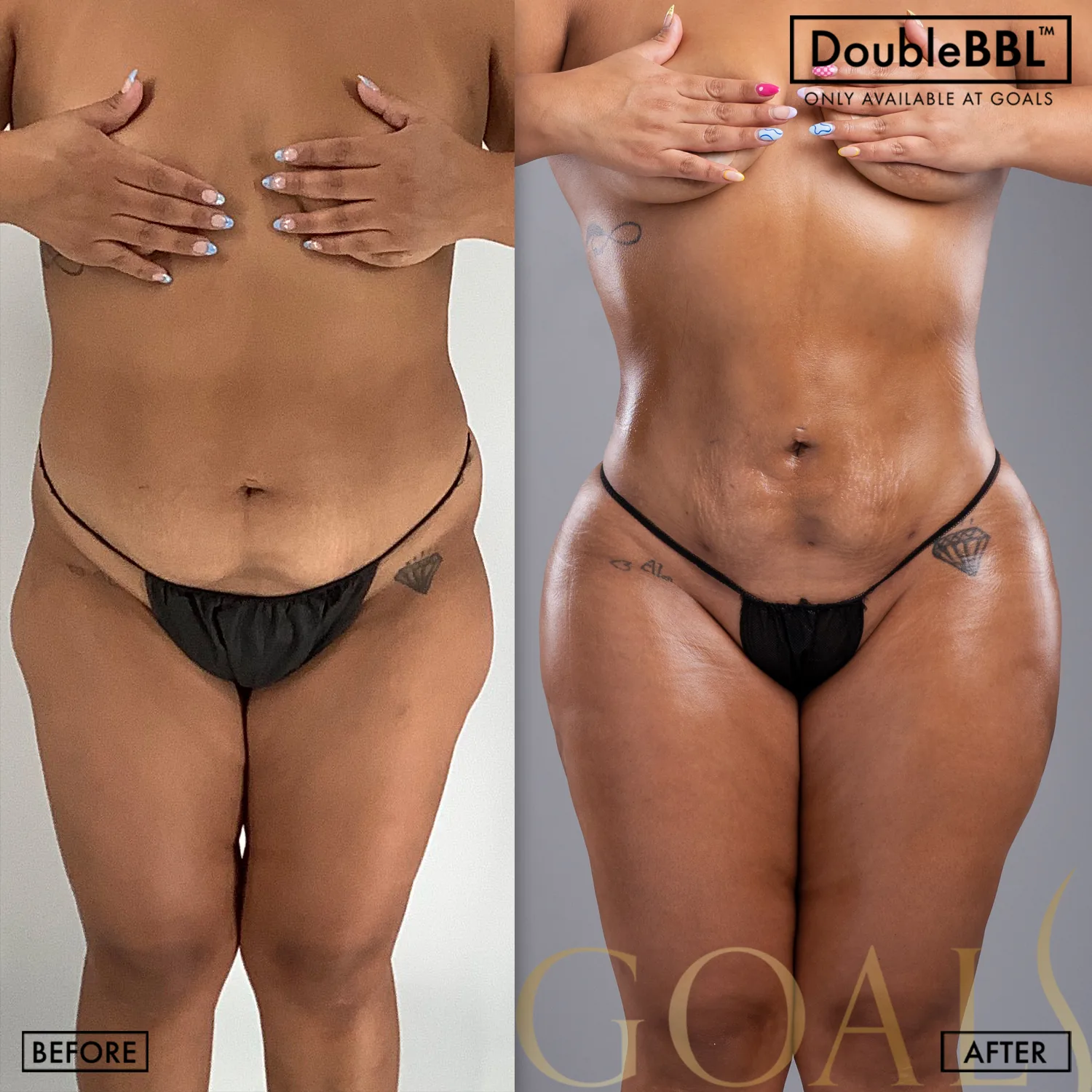 Before and after — Brazilian Butt Lift · Bronx, patient 2