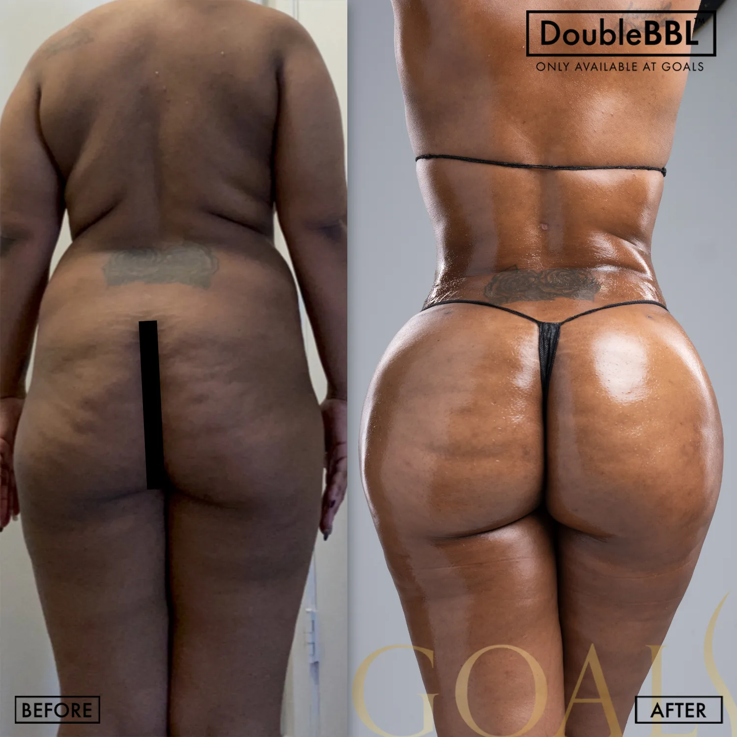 Before and after — Brazilian Butt Lift · Bronx, patient 3
