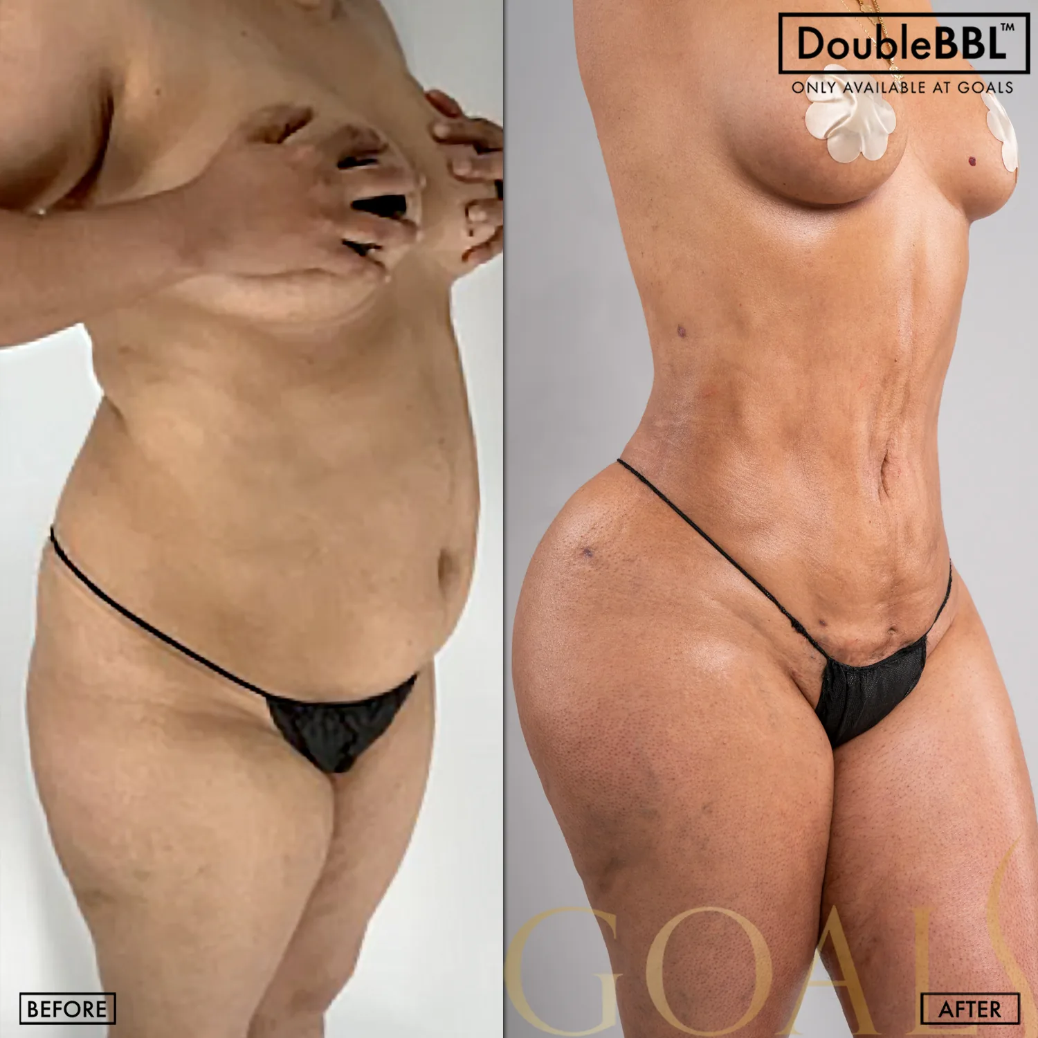 Before and after — Brazilian Butt Lift · Bronx, patient 4