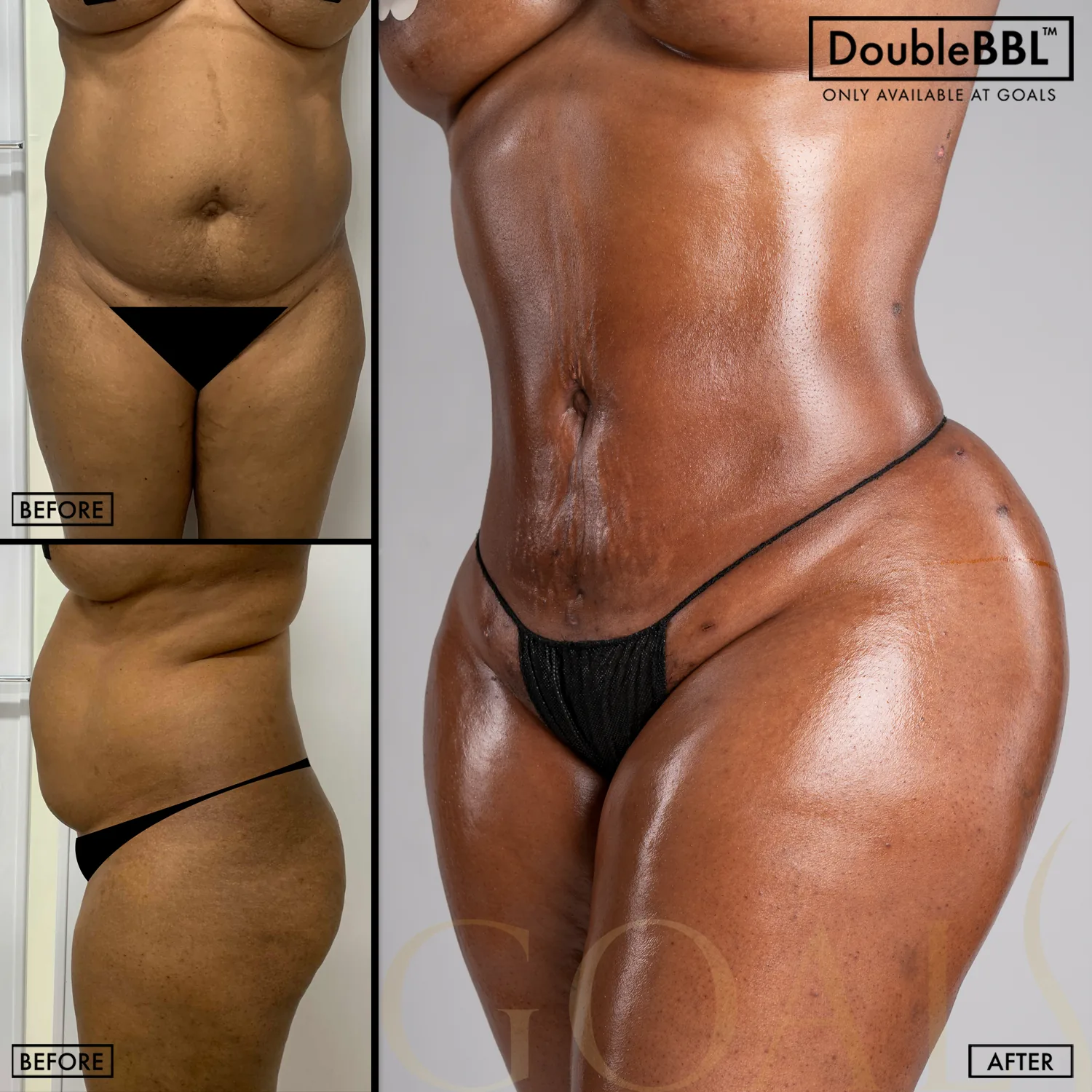 Before and after — Brazilian Butt Lift · Bronx, patient 6