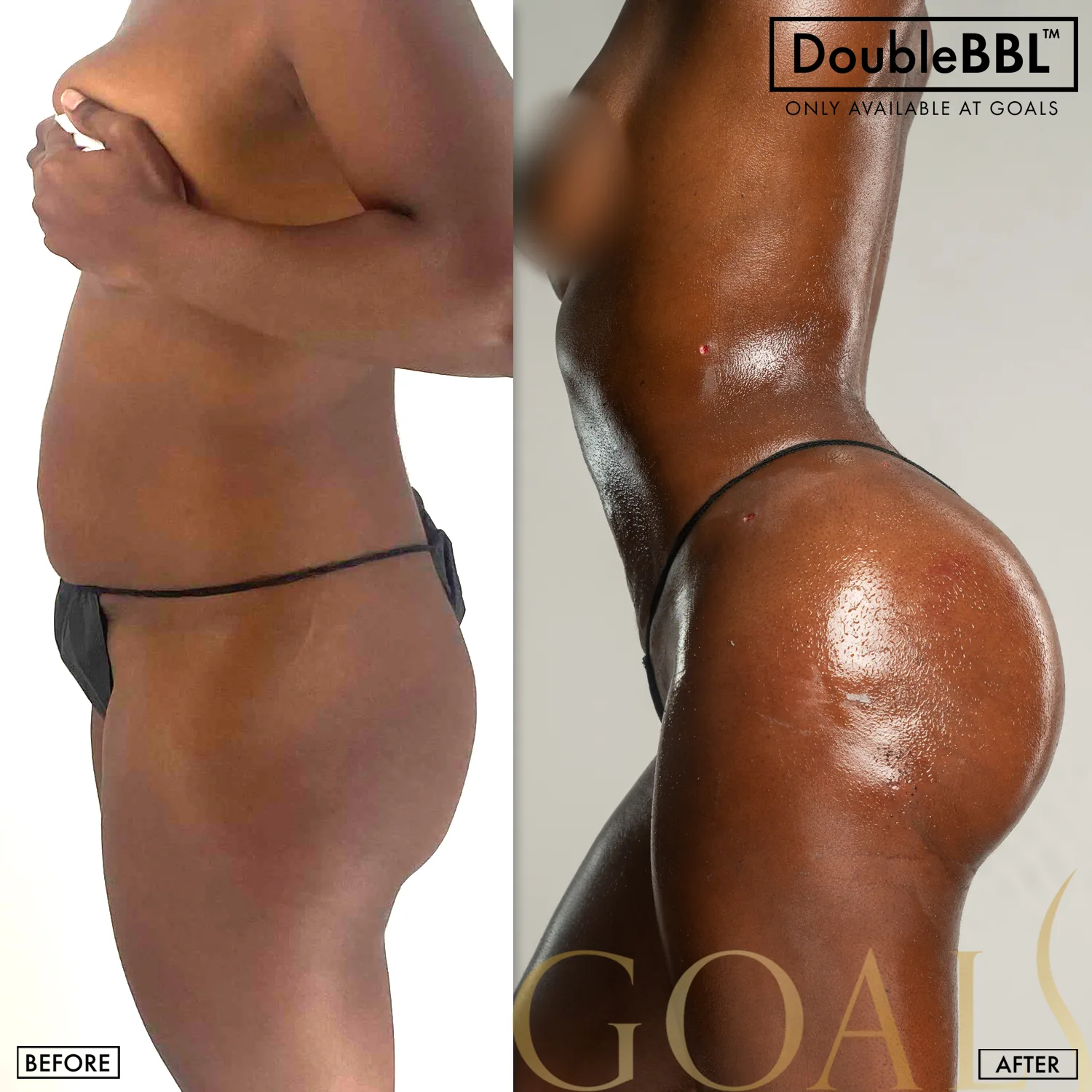 Before and after — Brazilian Butt Lift, patient 2