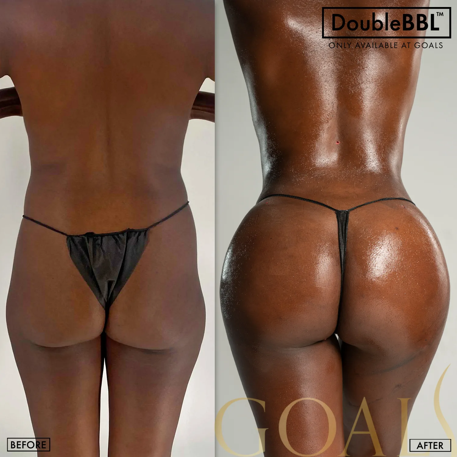 Before and after — Brazilian Butt Lift, patient 3