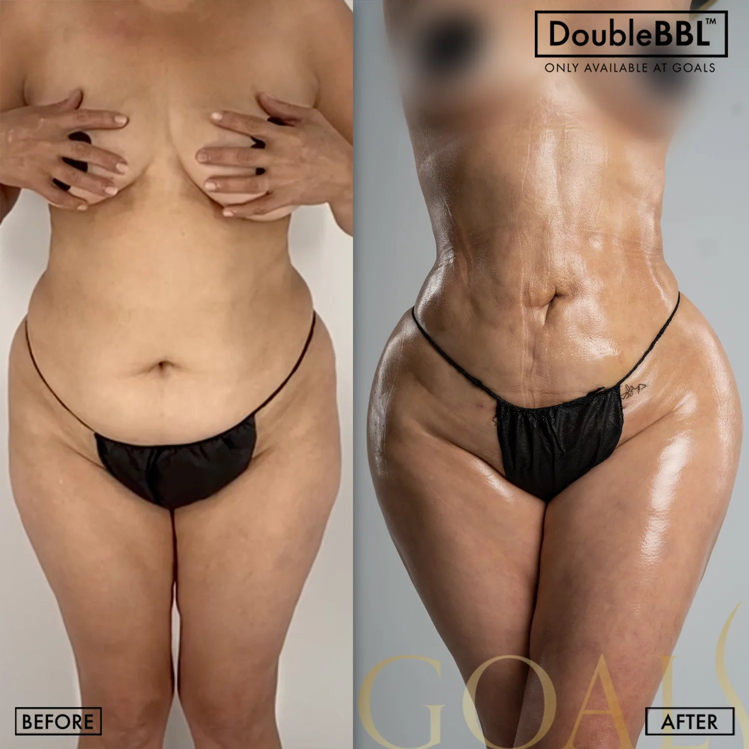 Before and after — Gaithersburg, patient 1