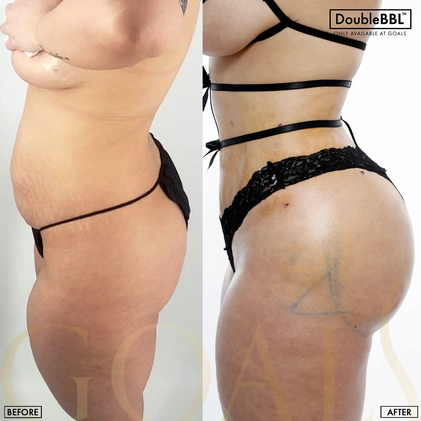 Before and after — Gaithersburg, patient 2