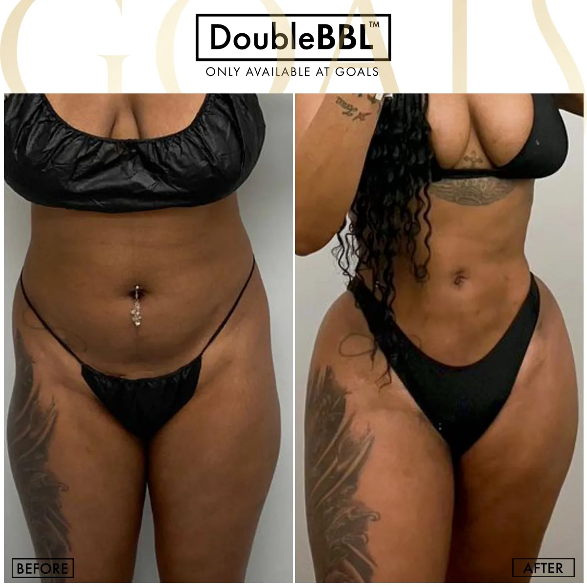 Before and after — Brooklyn, patient 2