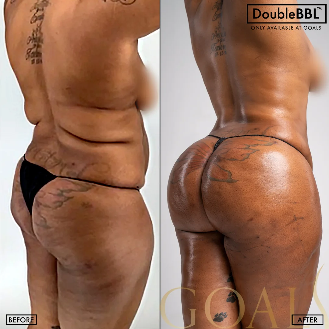 Before and after — Bronx, patient 6