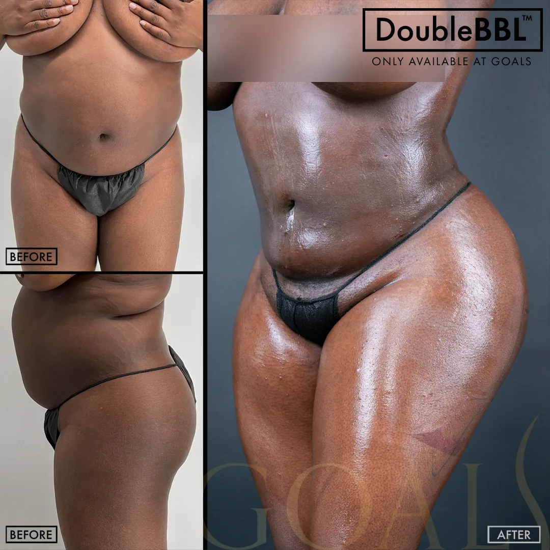 Before and after — Los Angeles, patient 4